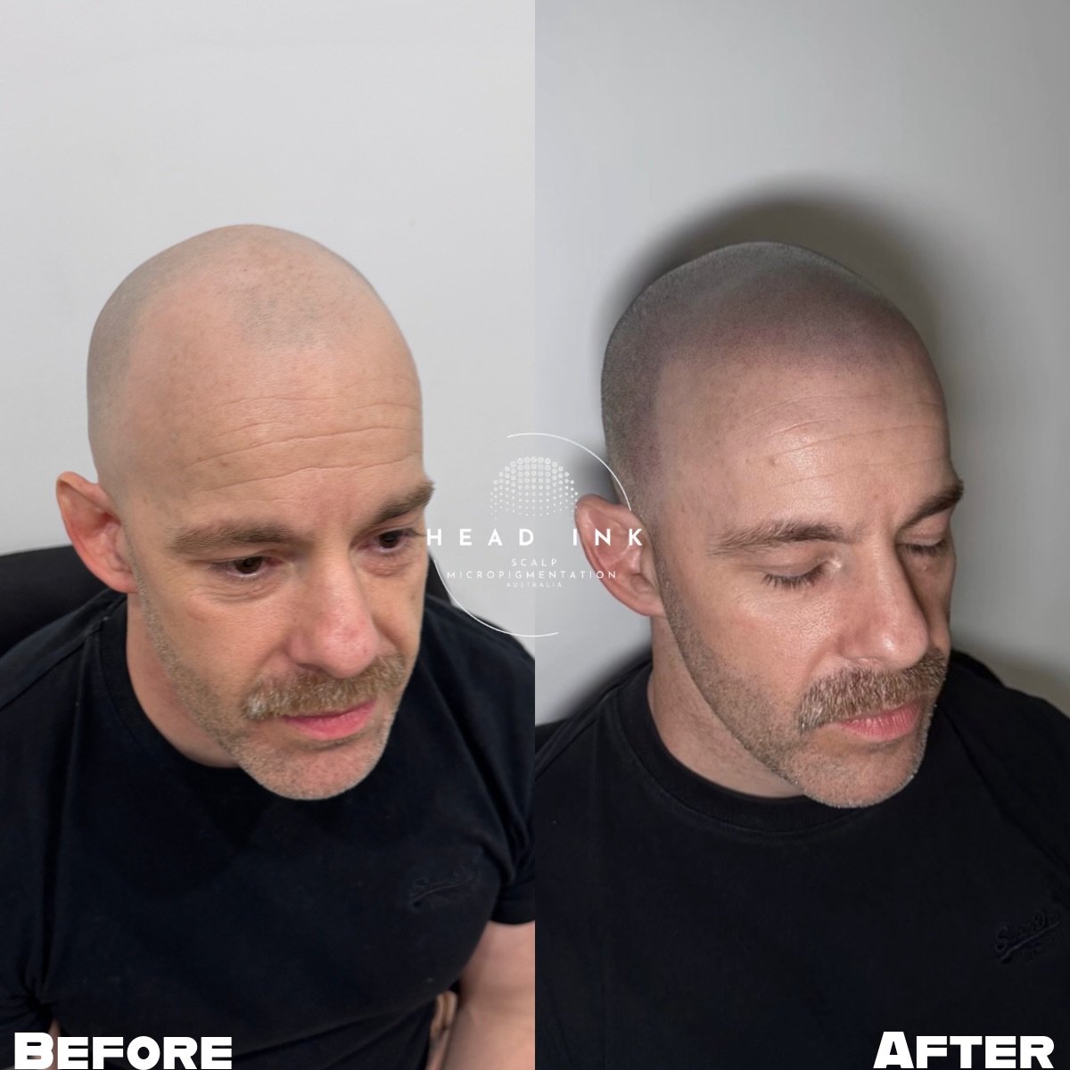 HE DROVE 5 HOURS EACH WAY FOR THIS HAIRLINE. 🤯🚗

And looking at the result, you can see why.
This client wanted a completely fresh, sharp shaved look that didn&rsquo;t just hide his hair loss&mdash;it defined his profile. Head Ink SMP provided a fu