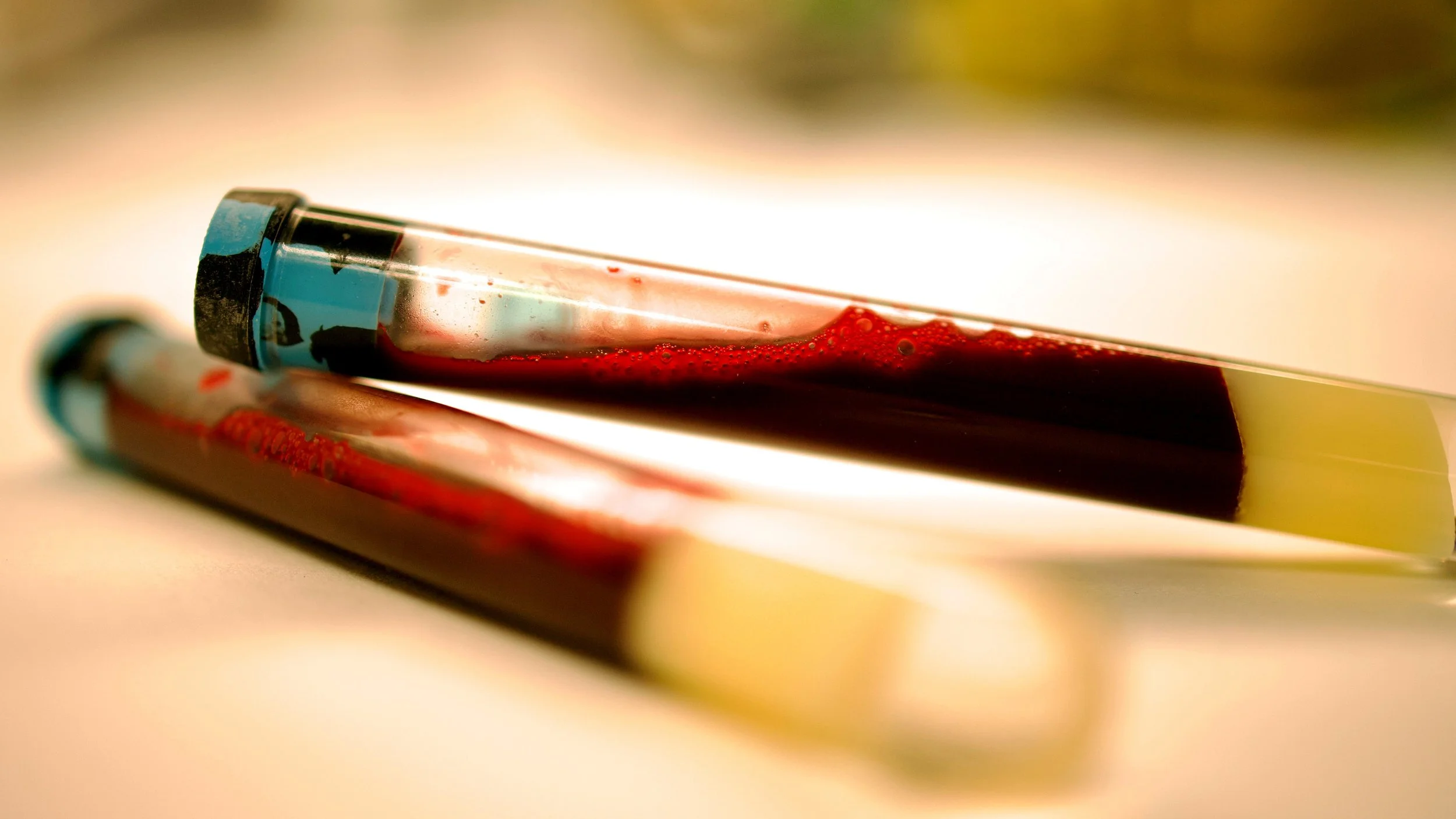 Muestra de sangre analizada en laboratorio. Un estudio liderado por la Universidad Tecnológica de Chalmers ha identificado biomarcadores tempranos del párkinson que podrían permitir su detección antes de que aparezcan los síntomas.