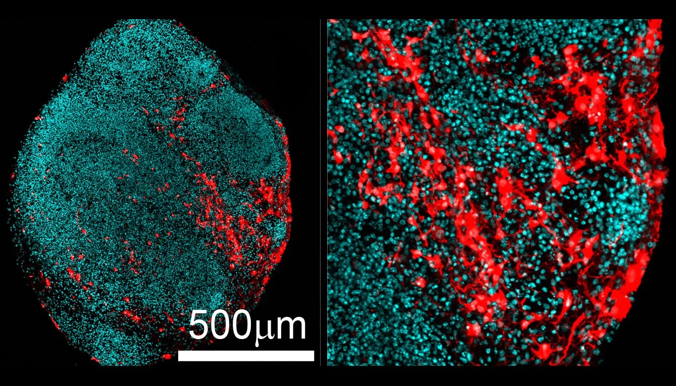 Organoide cerebral humano de 89 días: las células normales aparecen en azul y las células con la mutación, en rojo.
