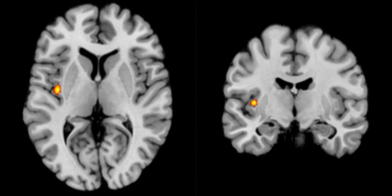 Resonancia magnética de un cerebro humano en la que se aprecia la ínsula activa.