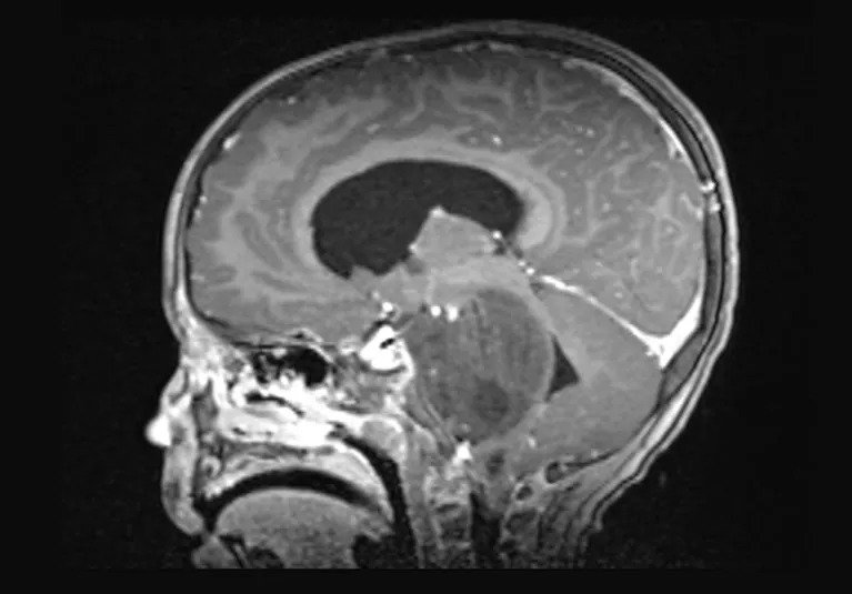 New Drug Boosts Survival From Devastating Brain Tumor
