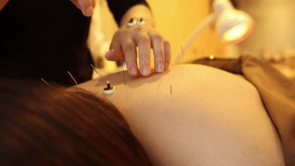 La acupuntura puede reducir el dolor de la migraña, y los escáneres cerebrales revelan quién responderá mejor