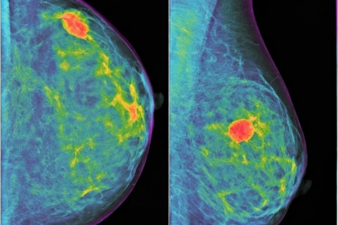 Vacuna personalizada contra el cáncer de mama triple negativo: cómo funciona y por qué podría cambiar el tratamiento en cuatro años