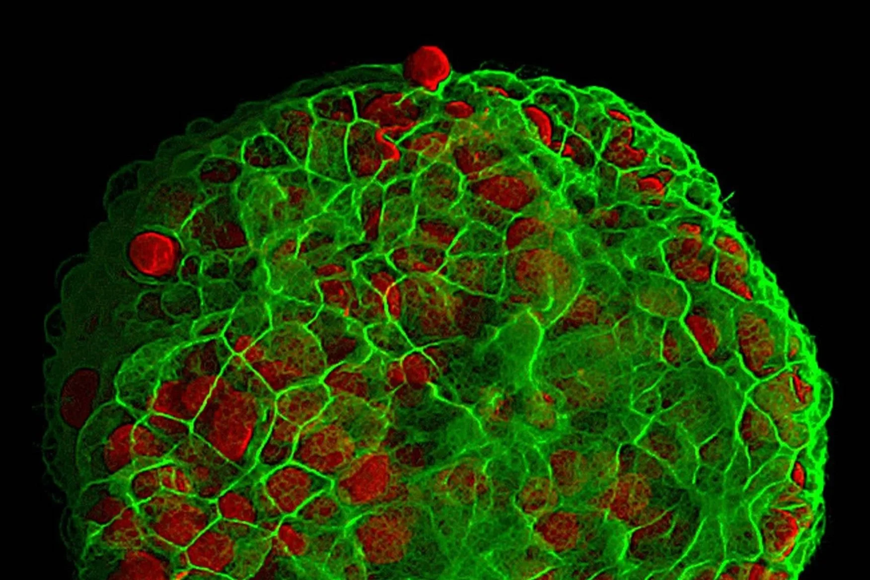 Descubren que el tejido que rodea al tumor puede activar la metástasis del cáncer de mama