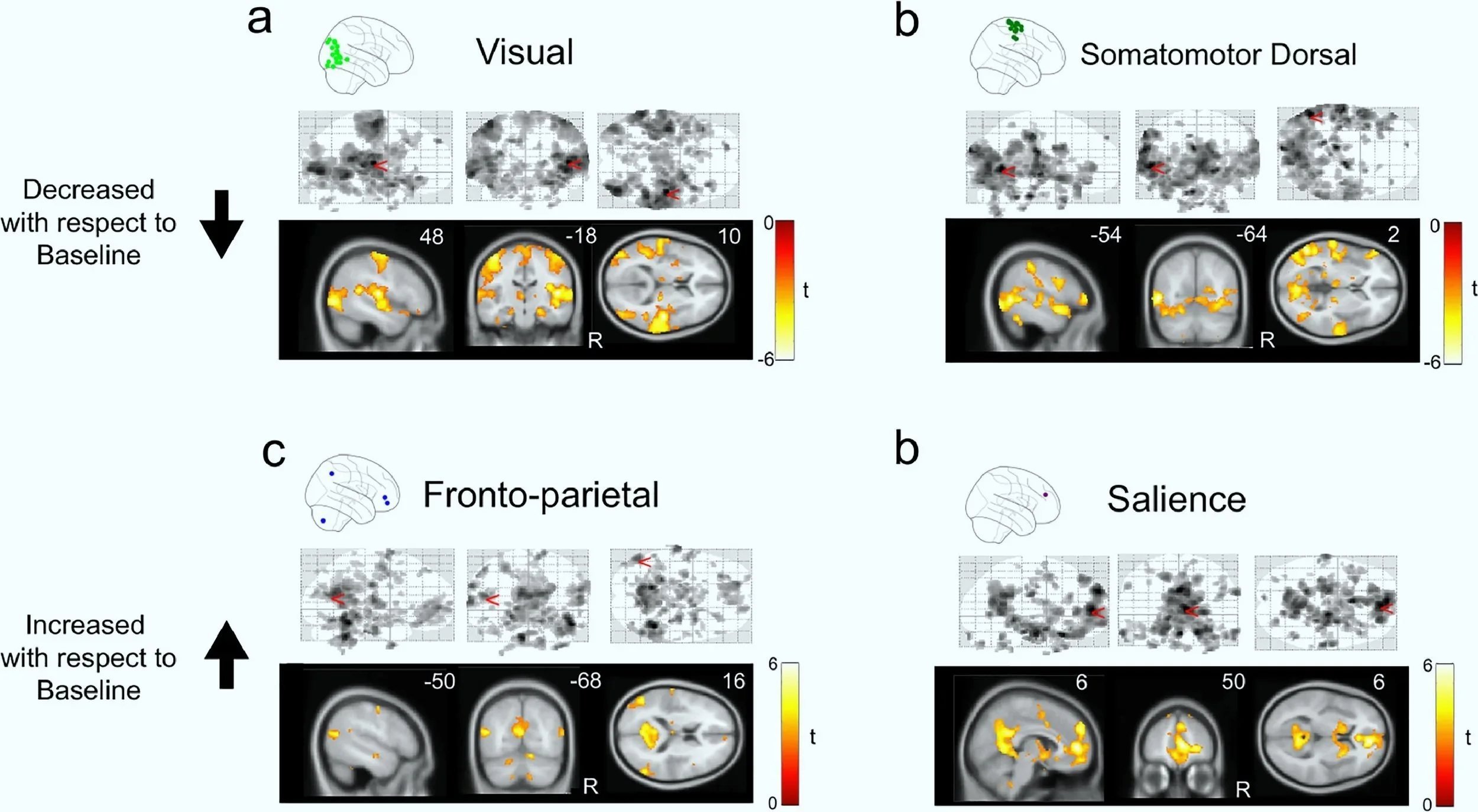 Mapas de conectividad cerebral por redes durante el estado alterado de la mujer que participó en el estudio.
