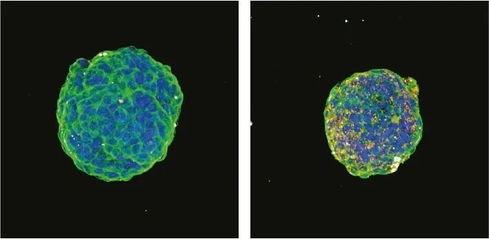 Frente al esferoide tumoral de control (izquierda), el tratamiento con un oligonucleótido dirigido contra KRAS (derecha) reduce notablemente su tamaño en cultivo de laboratorio.
