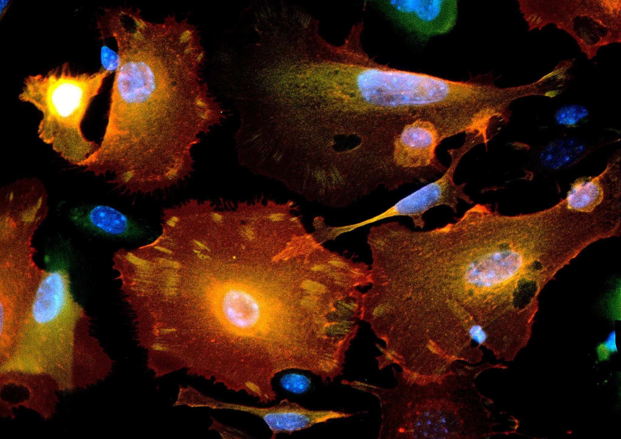 Células cancerosas de mama