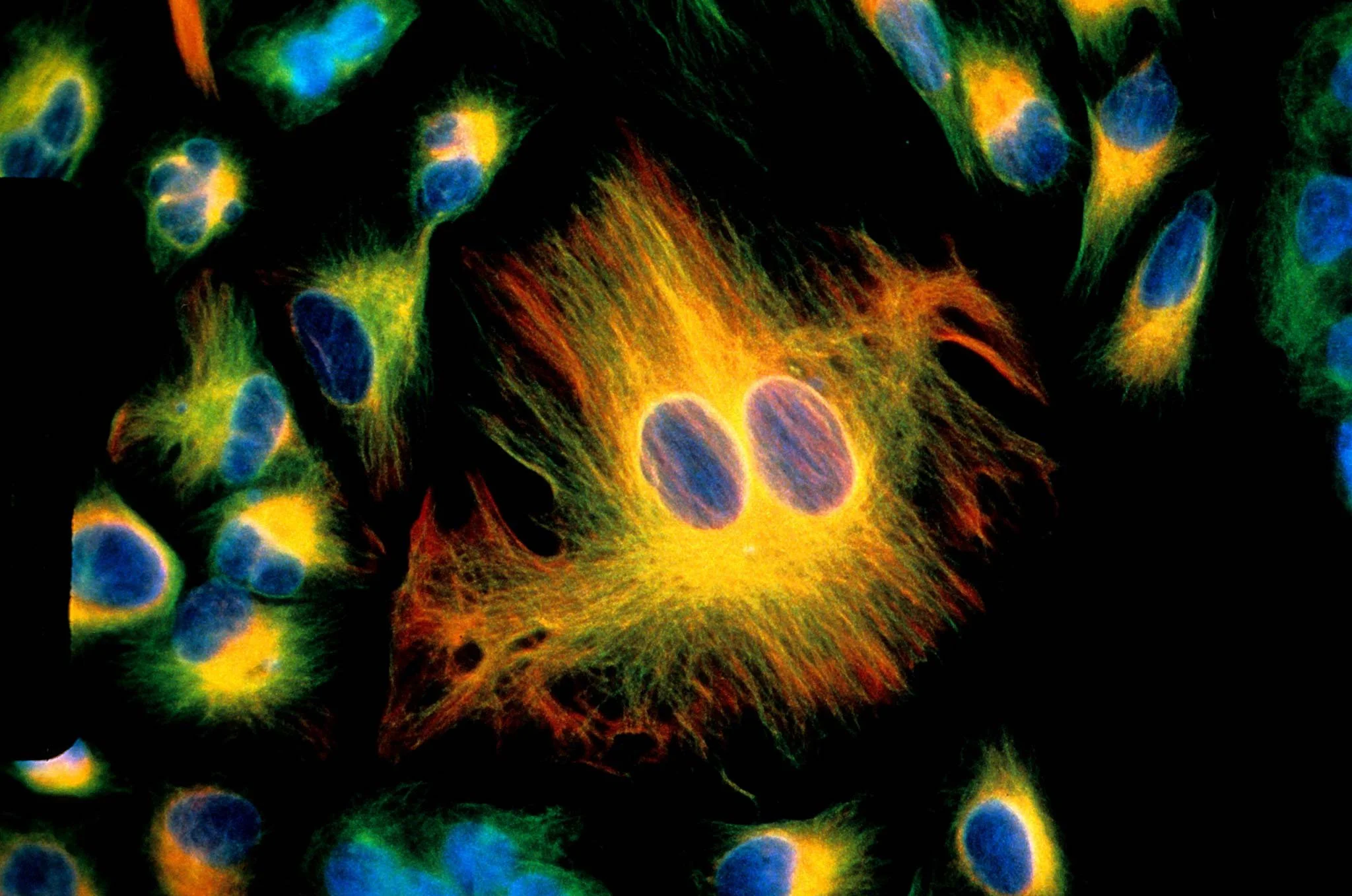 Micrografía de fluorescencia de un cultivo de células de melanoma y carcinoma. La imagen revela la compleja organización interna de las células tumorales, utilizada para estudiar su crecimiento y respuesta a nuevos tratamientos.