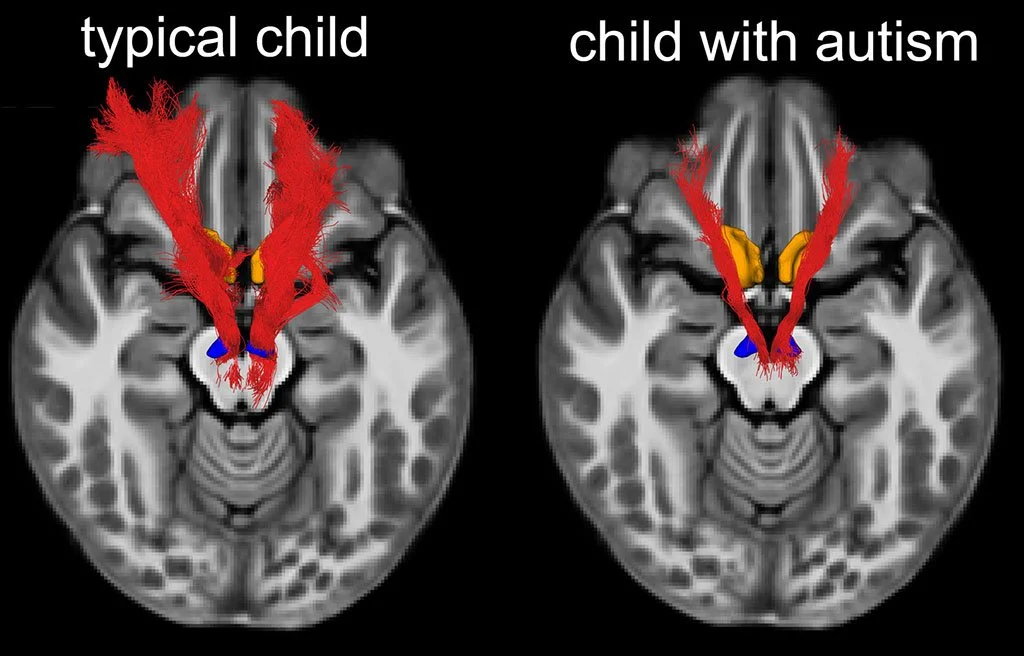 Estudios de resonancia magnética han mostrado que algunos niños con trastorno del espectro autista presentan una menor densidad de las fibras nerviosas que conectan regiones cerebrales implicadas en la recompensa social.