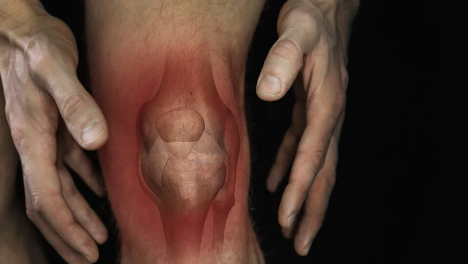 La artritis reumatoide provoca inflamación, hinchazón, rigidez y dolor en las articulaciones. Cuando la respuesta autoinmune no se controla, puede deteriorar progresivamente el cartílago y el hueso y limitar de manera considerable la movilidad.