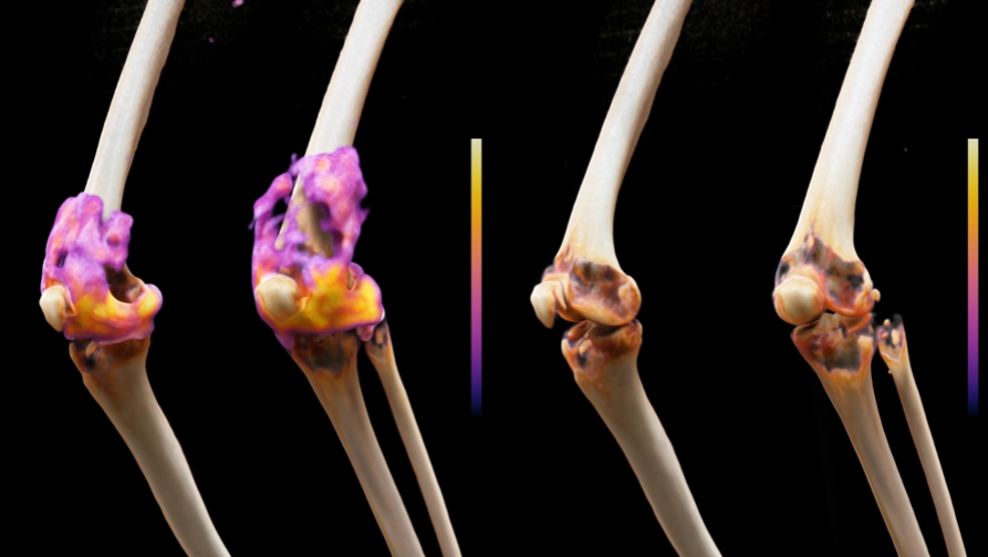 Las imágenes combinadas de PET y resonancia magnética muestran las rodillas de un participante antes del tratamiento (izquierda), con numerosos focos inflamatorios resaltados en magenta, y varios meses después de recibir la terapia CAR-T anti-CD19.