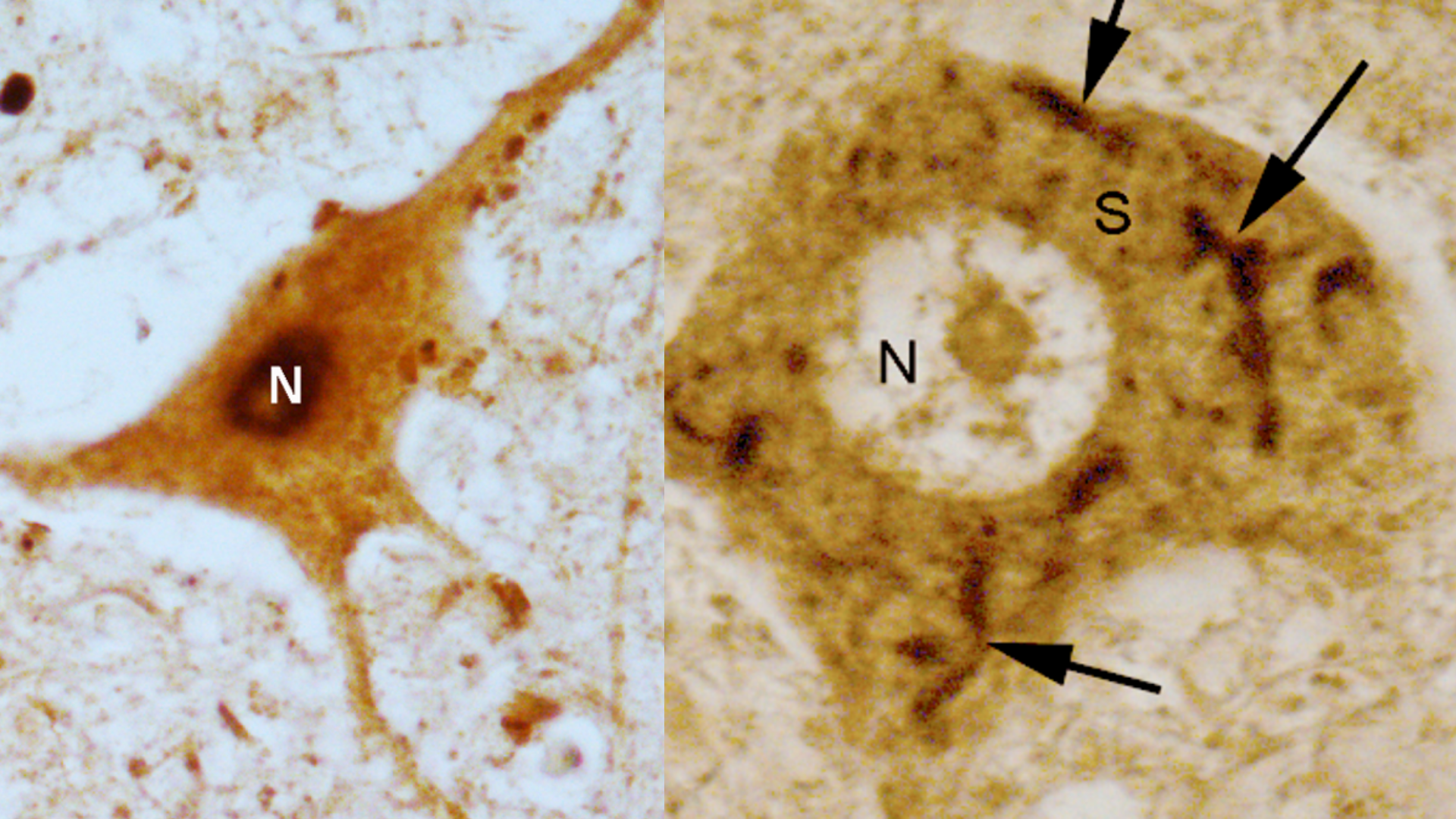 Motoneuronas de la médula espinal: a la izquierda, una neurona sana en la que la proteína TDP-43 (en negro) se localiza en el núcleo (N); a la derecha, una neurona de un paciente con ELA.