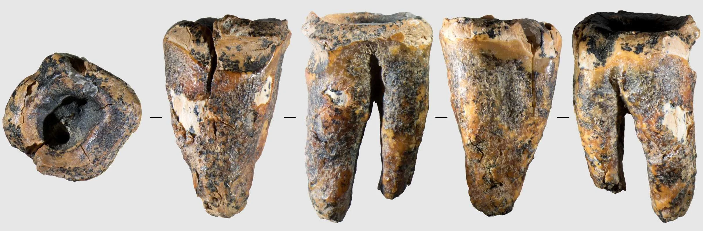 Vista general del molar neandertal Chagyrskaya 64 en cinco proyecciones. La gran cavidad central presenta señales compatibles con una intervención dental realizada hace unos 59.000 años con herramientas de piedra.