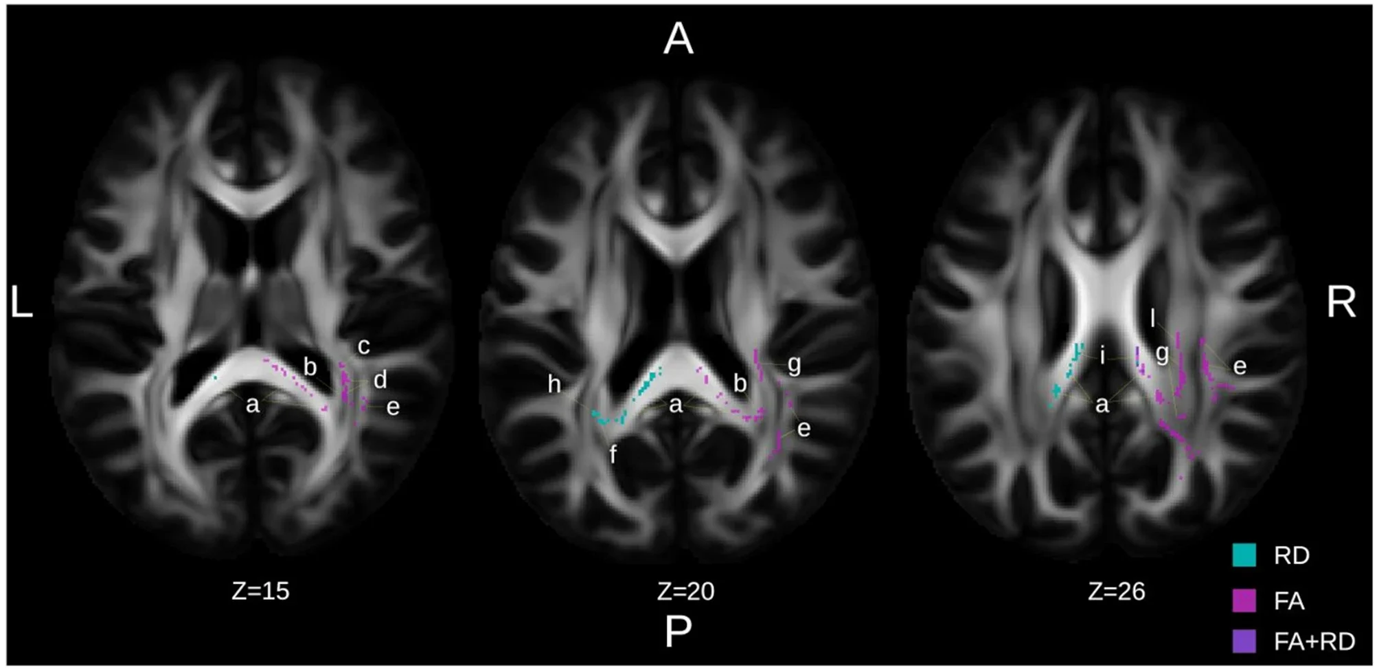 Imagen de resonancia magnética que muestra cambios en la sustancia blanca del cerebro tras el entrenamiento con exergames.