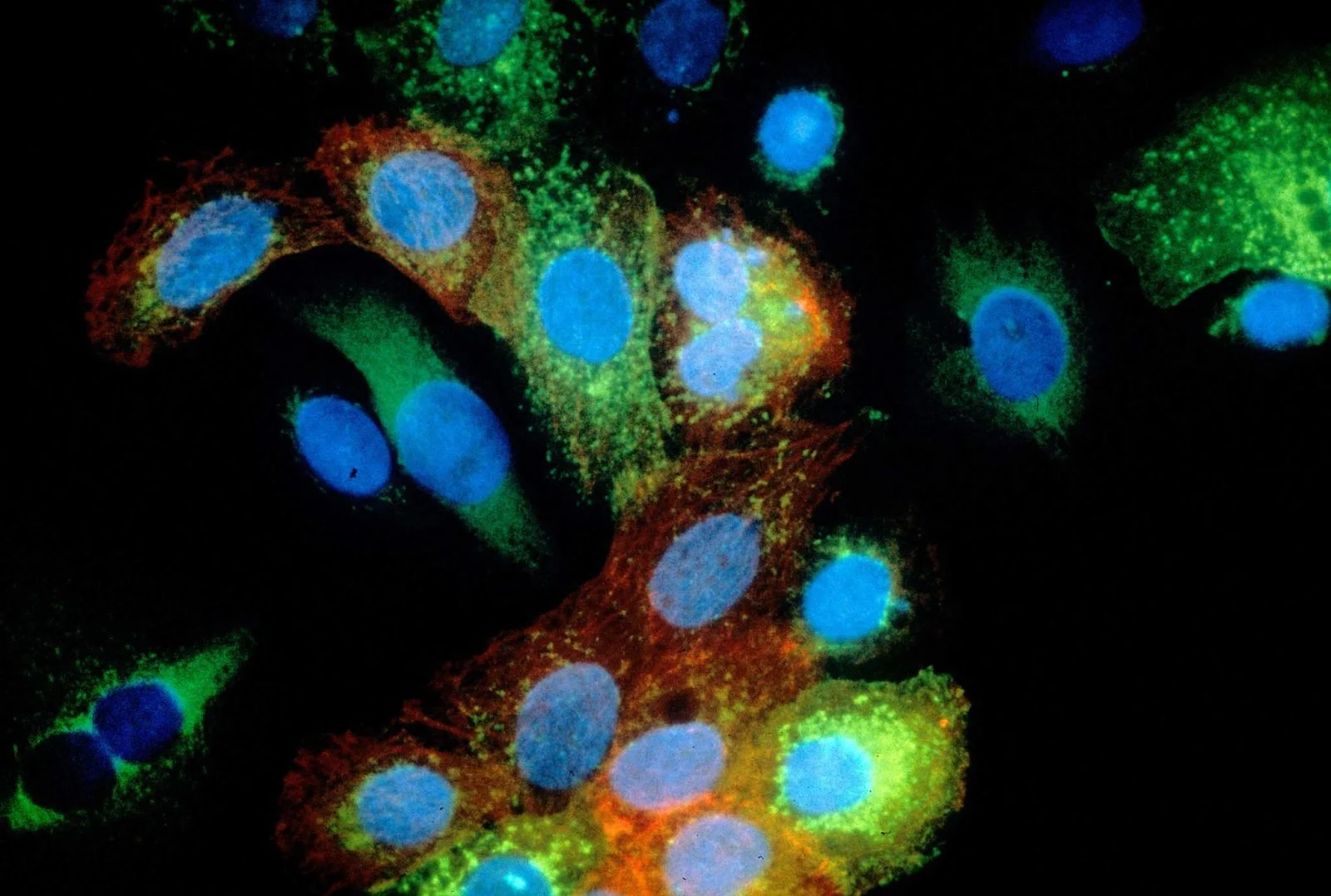 Cultivo de células de cáncer de piel.