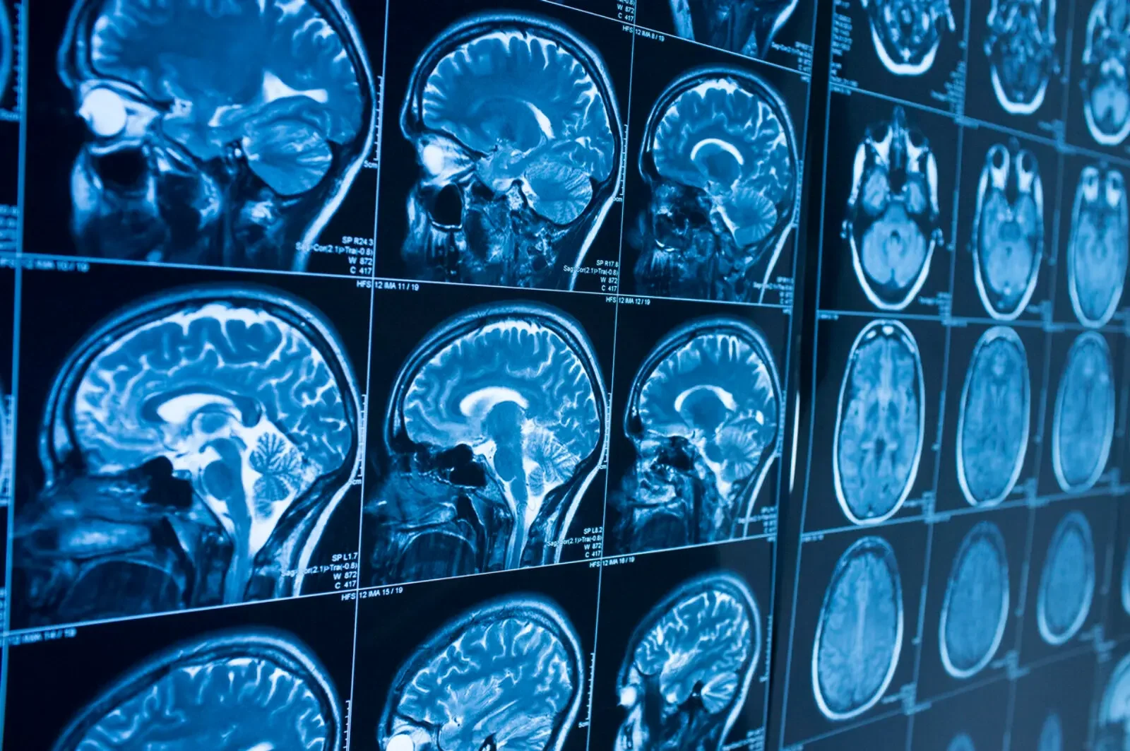 Imágenes de resonancia magnética que permiten observar con detalle la estructura del cerebro humano, cuya corteza experimenta una intensa reorganización neuronal durante el desarrollo.