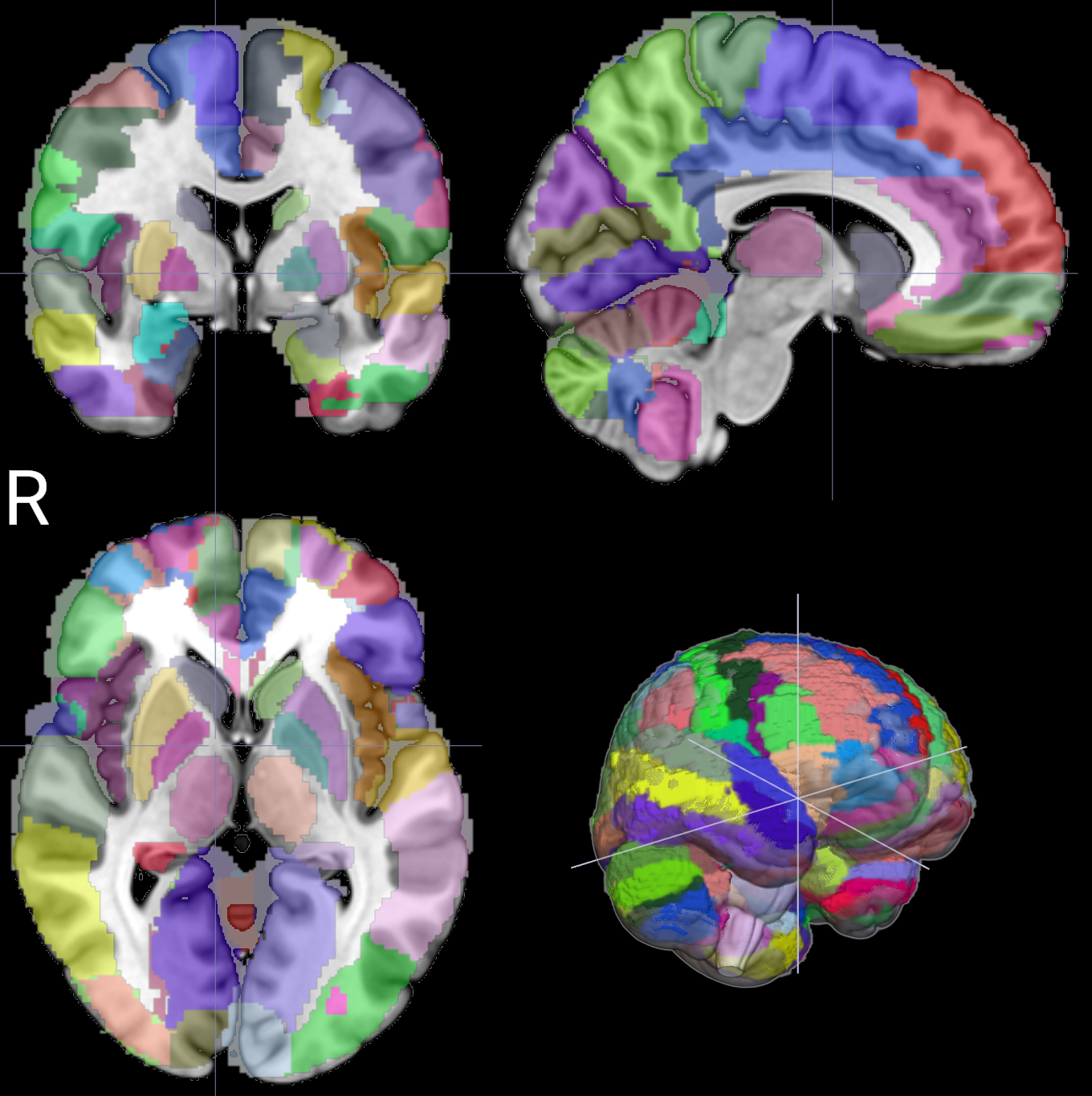 Imágenes de resonancia magnética cerebral con distintas regiones anatómicas identificadas mediante colores. Esta técnica permite estudiar la estructura del cerebro y explorar posibles diferencias relacionadas con el TDAH.