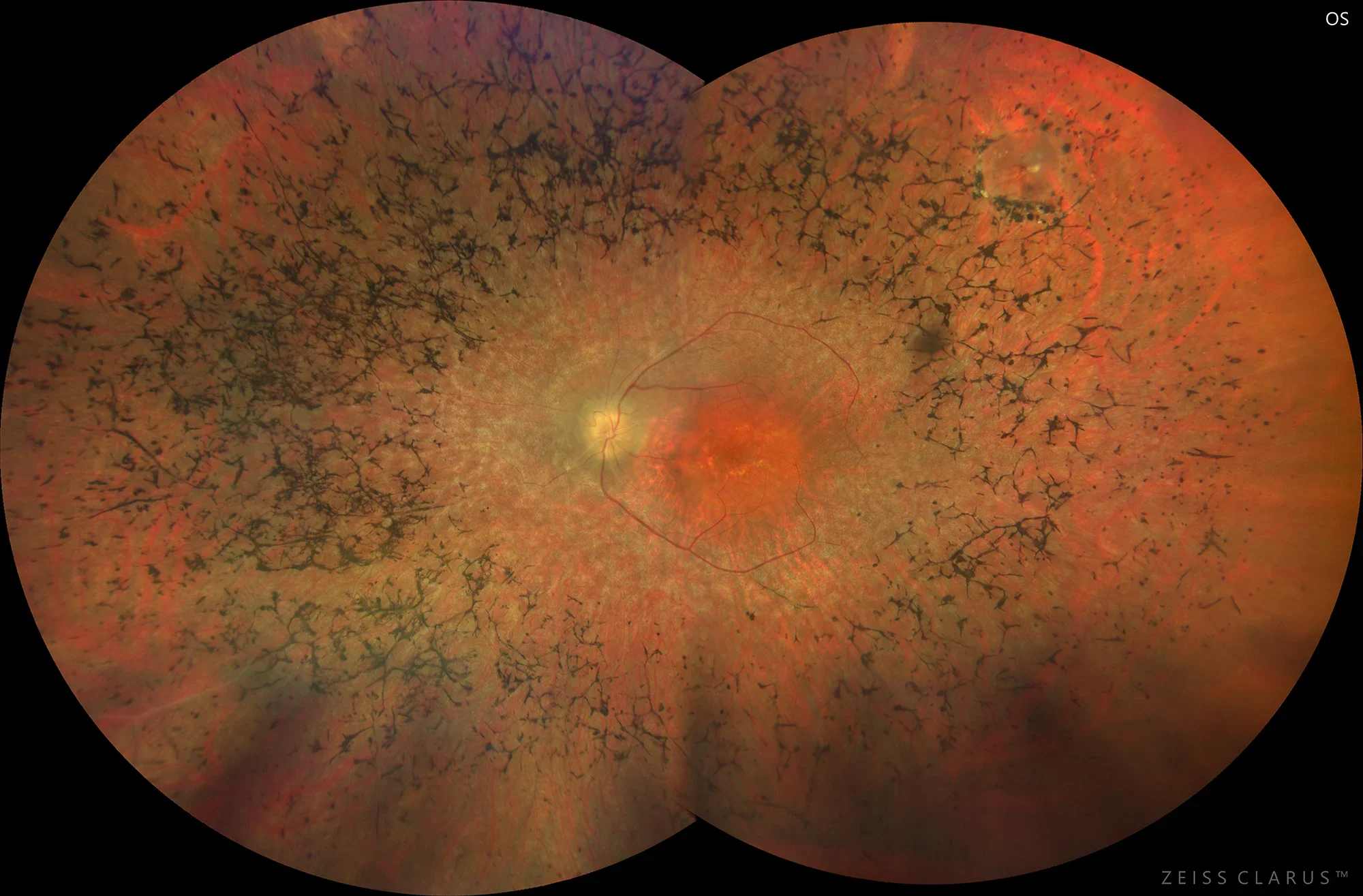 Retinografía de un ojo con retinosis pigmentaria. Se aprecian depósitos oscuros característicos, vasos sanguíneos estrechados y palidez del disco óptico.