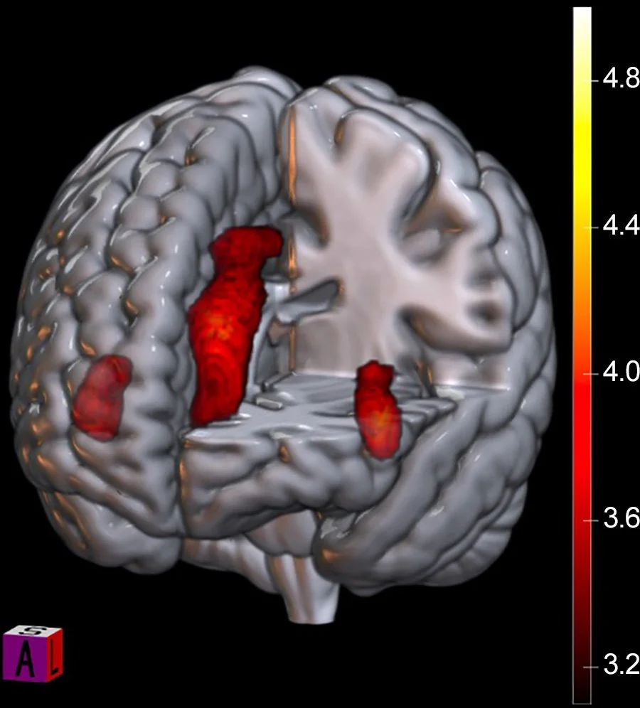 Visualización de los efectos cerebrales de una derrota significativa: la red de saliencia se desactiva cuando el equipo pierde. Los colores cálidos indican mayor activación y los fríos, desactivación relativa.