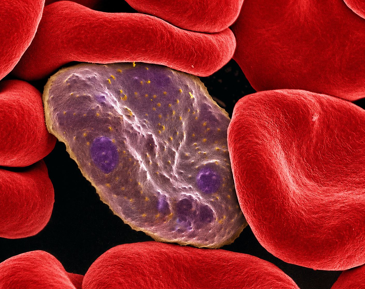 Micrografía electrónica coloreada de un glóbulo rojo infectado por Plasmodium falciparum.
