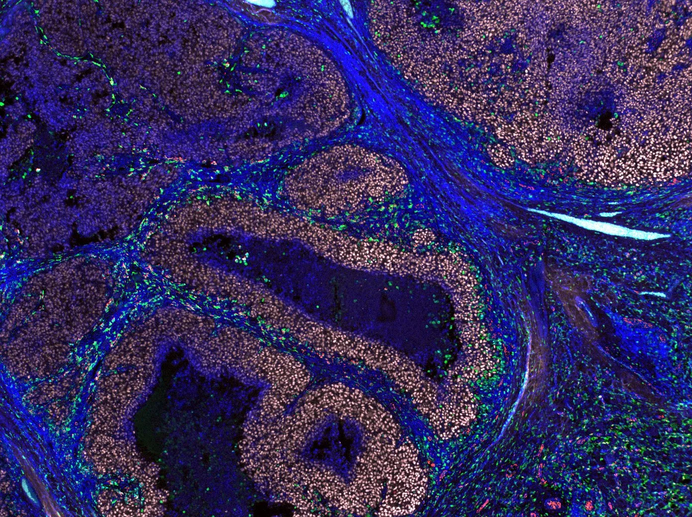 Imagen ampliada de un tumor de melanoma humano en la que se observan macrófagos CD169+ —resaltados en verde y rojo— agrupados alrededor de las células cancerosas —en rosa—, formando una primera línea de defensa inmunitaria frente al tumor.