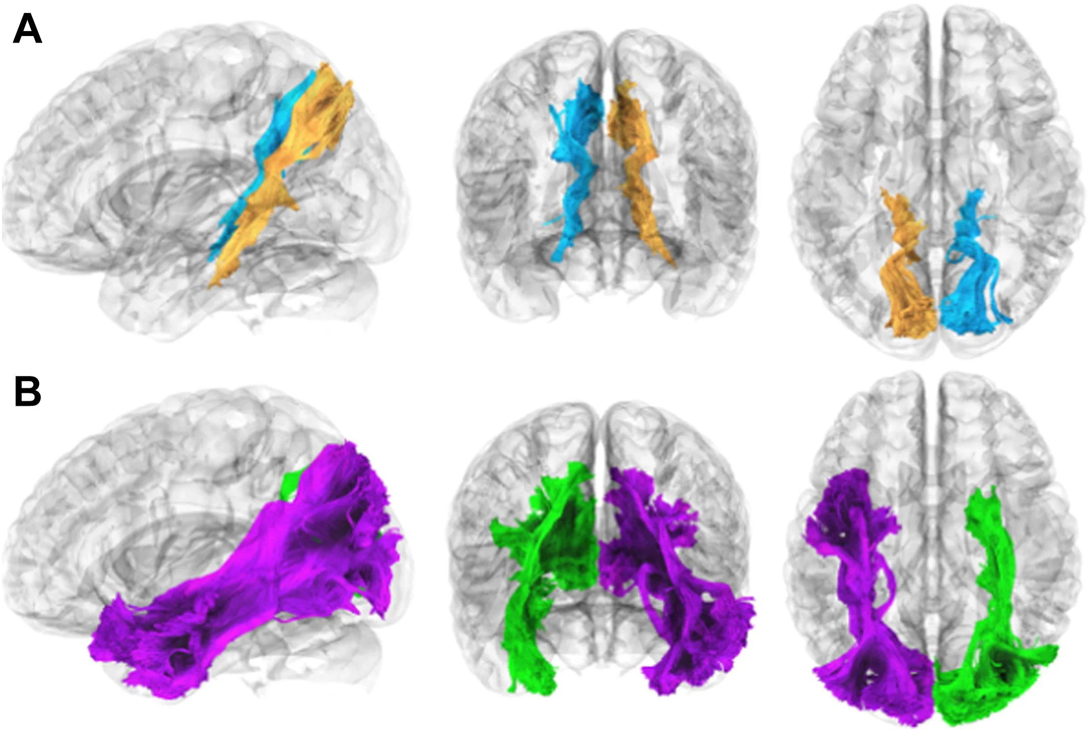 Reconstrucción 3Dde las principales vías de sustancia blanca analizadas en el estudio:  en la parte superior, se muestra el cíngulo parahipocampal-parietal, sociado a la aparición de recuerdos traumáticos intrusivos.