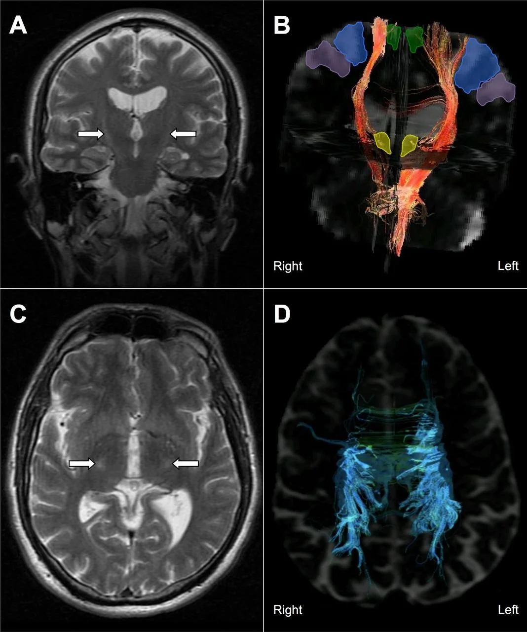 La resonancia magnética y la tractografía por tensor de difusión muestran el deterioro de las vías corticoespinales en un paciente con ELA.