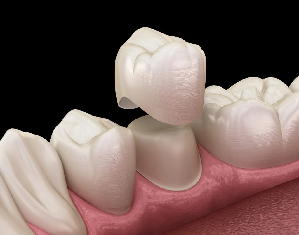Una corona dental es una funda fabricada a medida que recubre un diente dañado para devolverle su forma, resistencia y función.