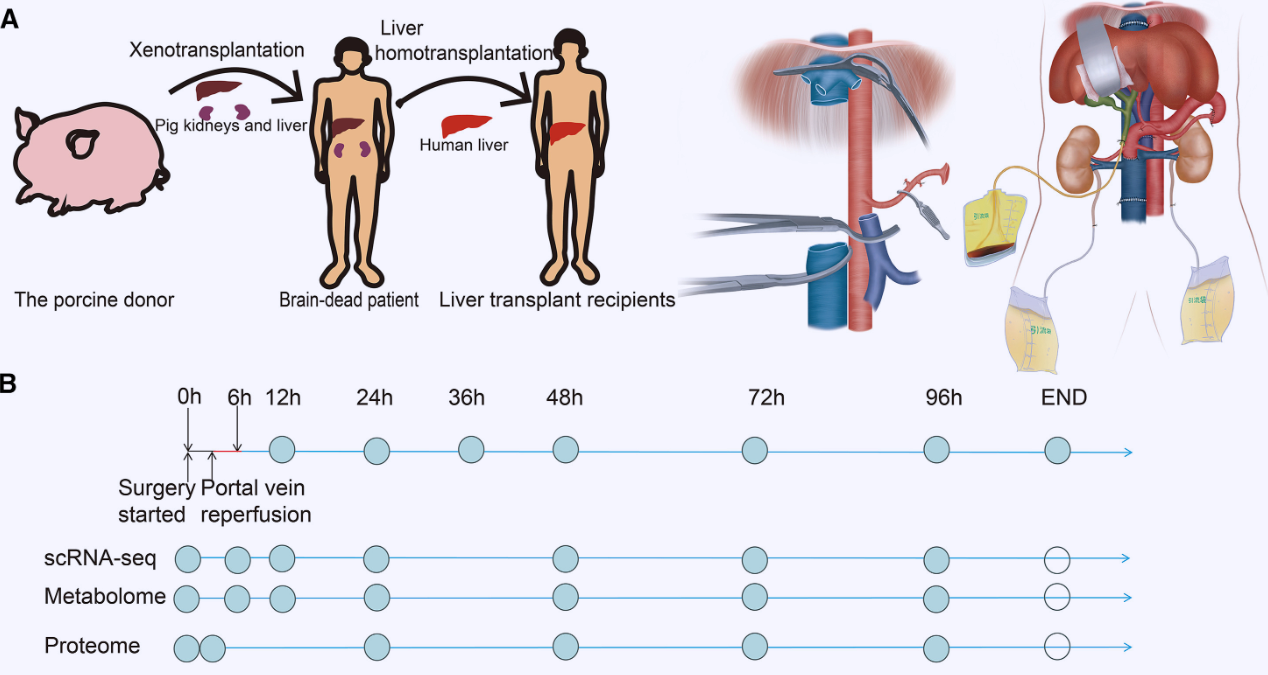 Esquema del diseño experimental utilizado en el estudio. Los investigadores trasplantaron simultáneamente un hígado y dos riñones de un cerdo modificado genéticamente a un paciente con muerte cerebral.