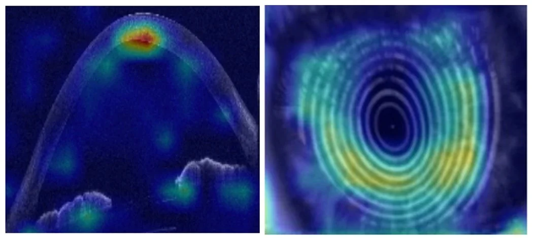 Ejemplo de exploración del ojo mediante tomografía de coherencia óptica (OCT) utilizada por la inteligencia artificial para el estudio de queratocono.