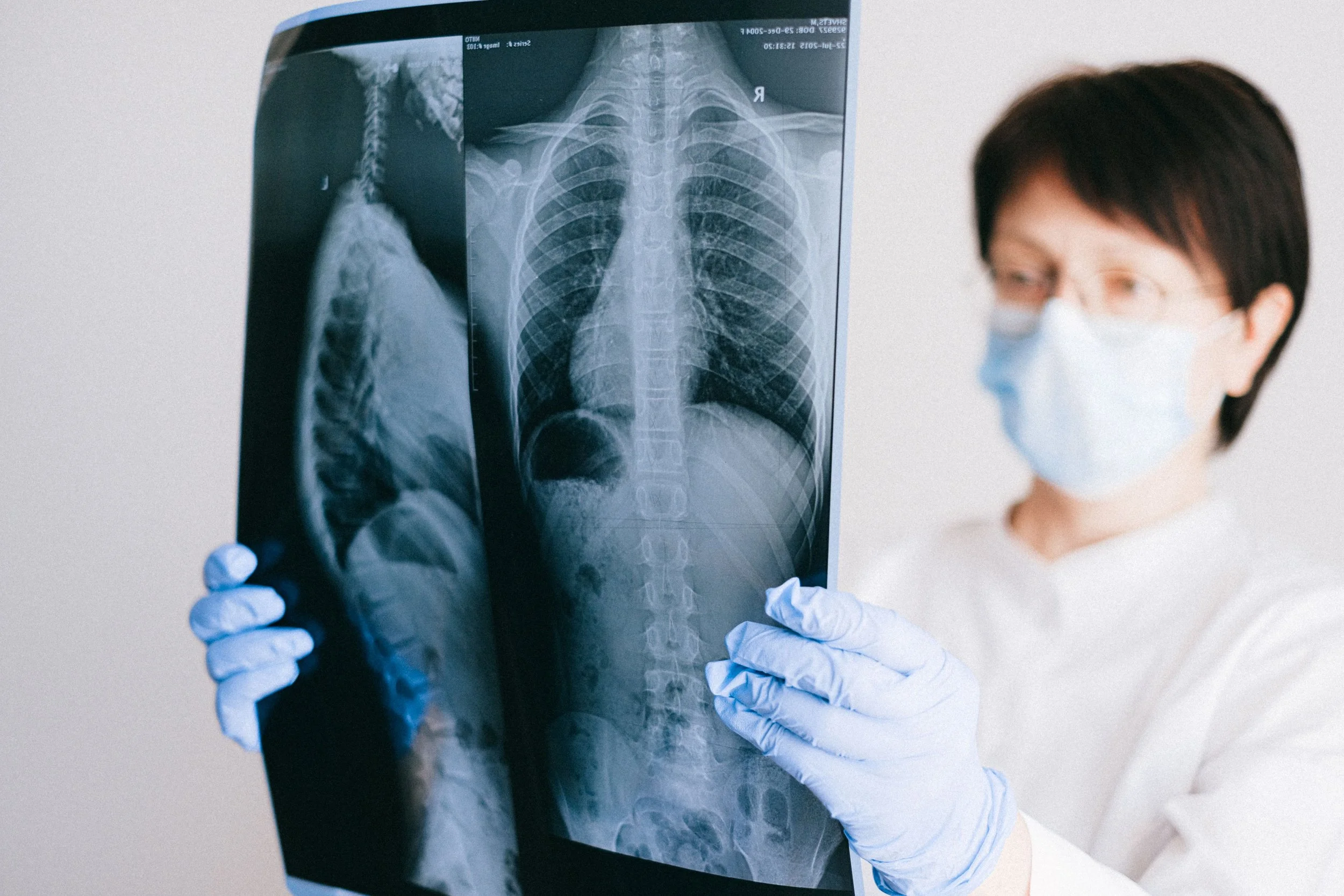 En la hipertensión pulmonar, el estrechamiento progresivo de los vasos de los pulmones dificulta el paso de la sangre y sobrecarga el corazón.