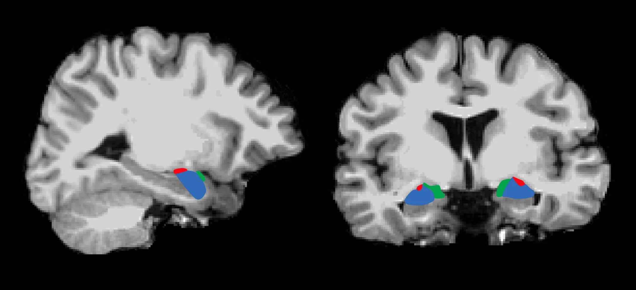 Imágenes de resonancia magnética (MRI T1) de la amígdala humana, una de las estructuras cerebrales que muestra asociación entre atrofia y pérdida de memoria con la edad, según el megaanálisis publicado en Nature Communications.