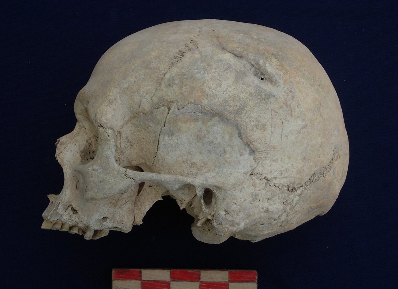 craneo con lesiones de hace 6.000 años