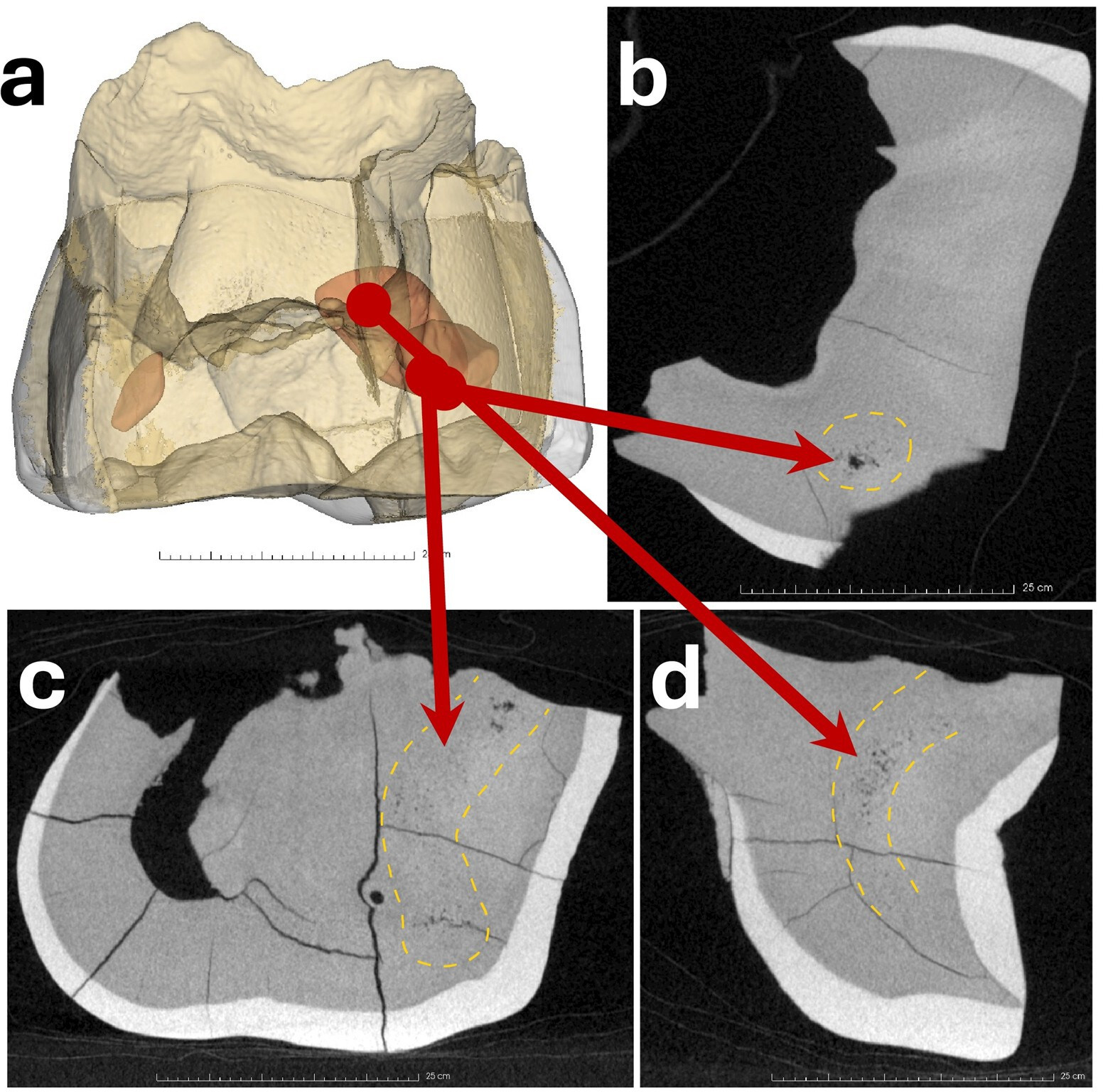 Reconstrucción virtual del molar de leche Sesselfelsgrotte 2 y detalle de las anomalías detectadas en su interior mediante microtomografía computarizada.