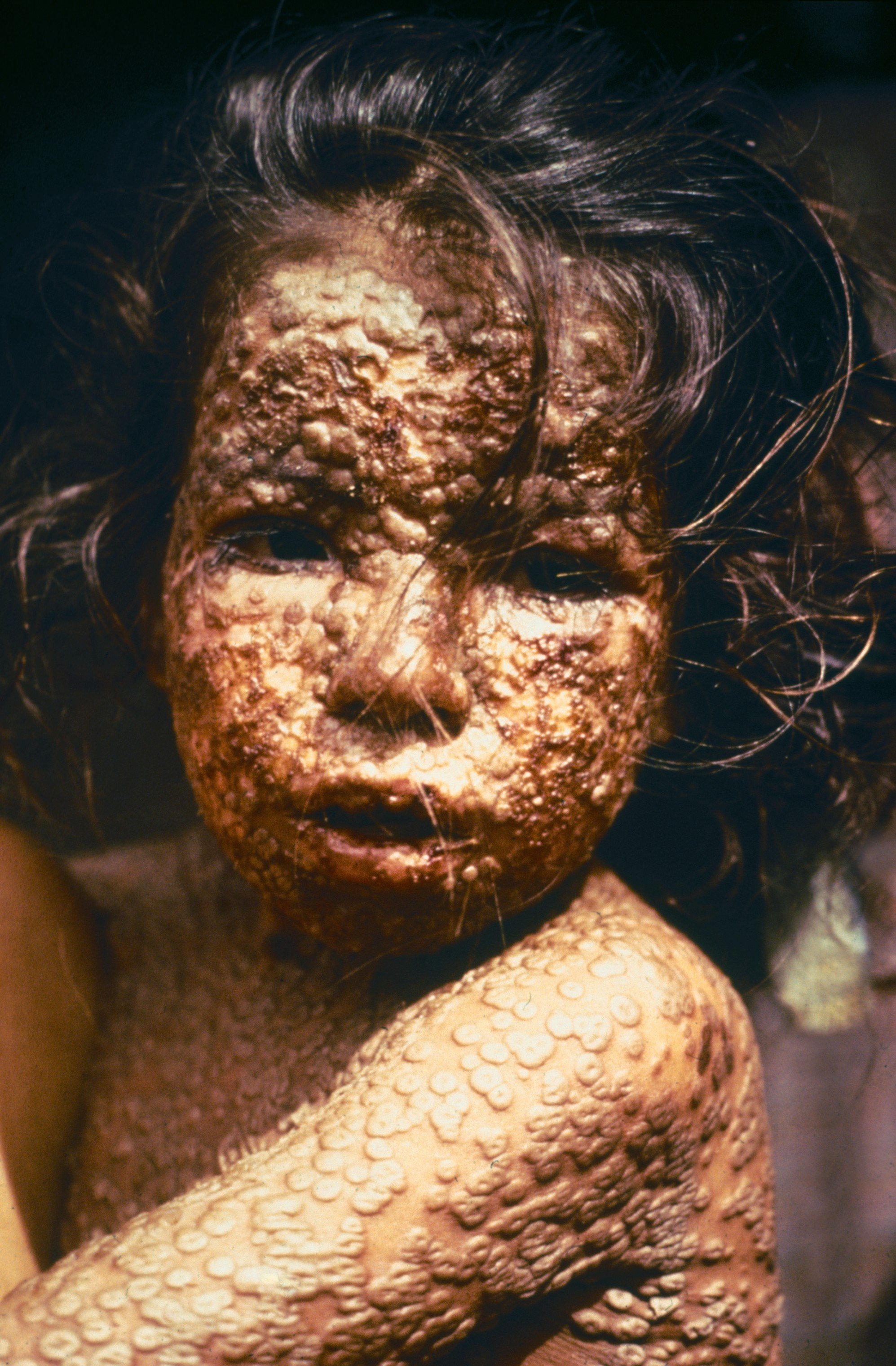 Una niña de Bangladesh afectada por la viruela en 1973, pocos años antes de que la enfermedad desapareciera definitivamente del país. La OMS certificó la erradicación de la viruela en Bangladesh en 1977.