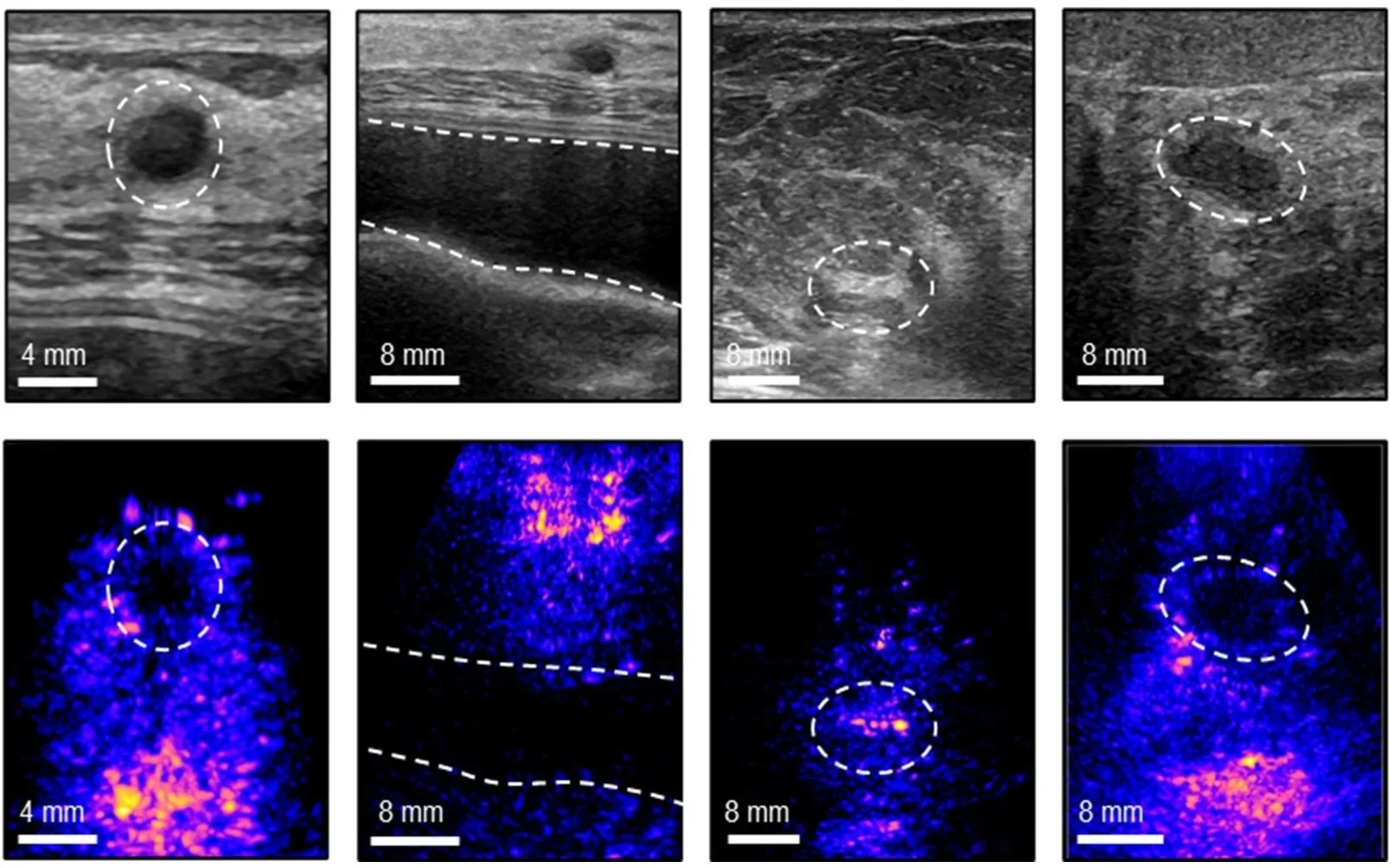 Comparación entre las imágenes obtenidas con un ecógrafo convencional (arriba) y el nuevo sistema portátil de ecografía 3D (abajo). De izquierda a derecha se observan un quiste, un implante mamario, tejido fibroso denso y una masa sólida.