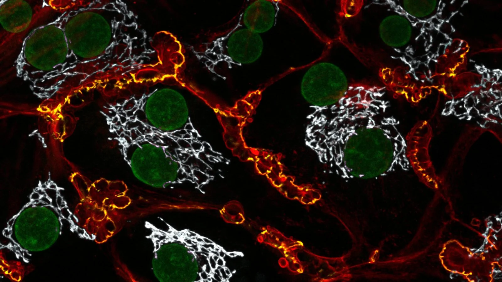 Células hepáticas. Bajo el bombardeo constante de grasas, estas células dejan de comportarse como hepatocitos maduros y especializados y empiezan a activar programas propios del desarrollo embrionario y de la regeneración tisular.