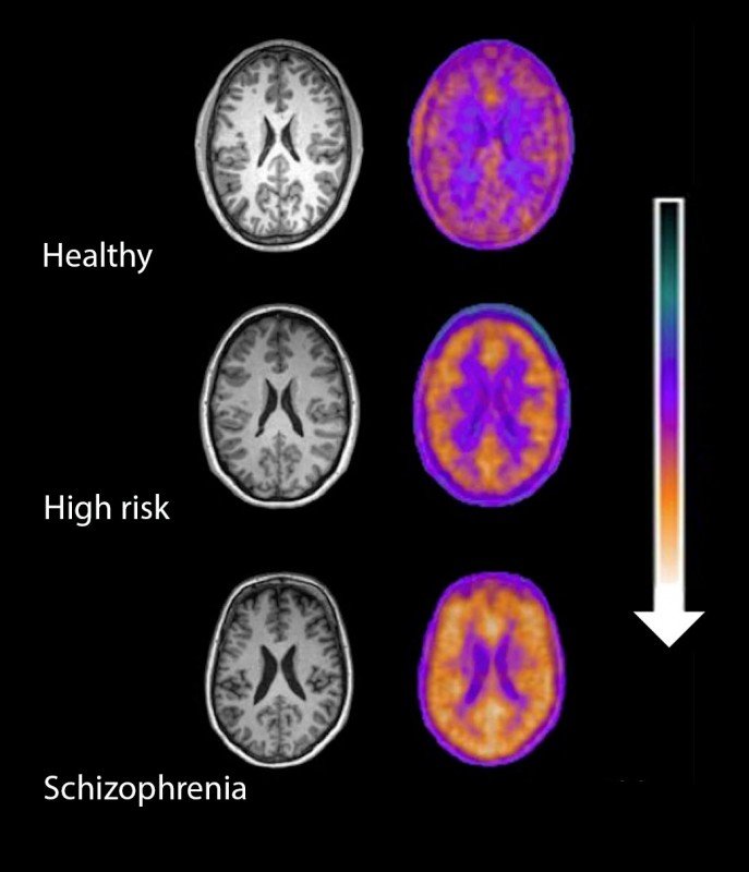 Escáneres cerebrales que muestran un aumento progresivo de la actividad de las células inmunitarias del cerebro (en naranja), desde individuos sanos hasta personas con alto riesgo y pacientes con esquizofrenia.
