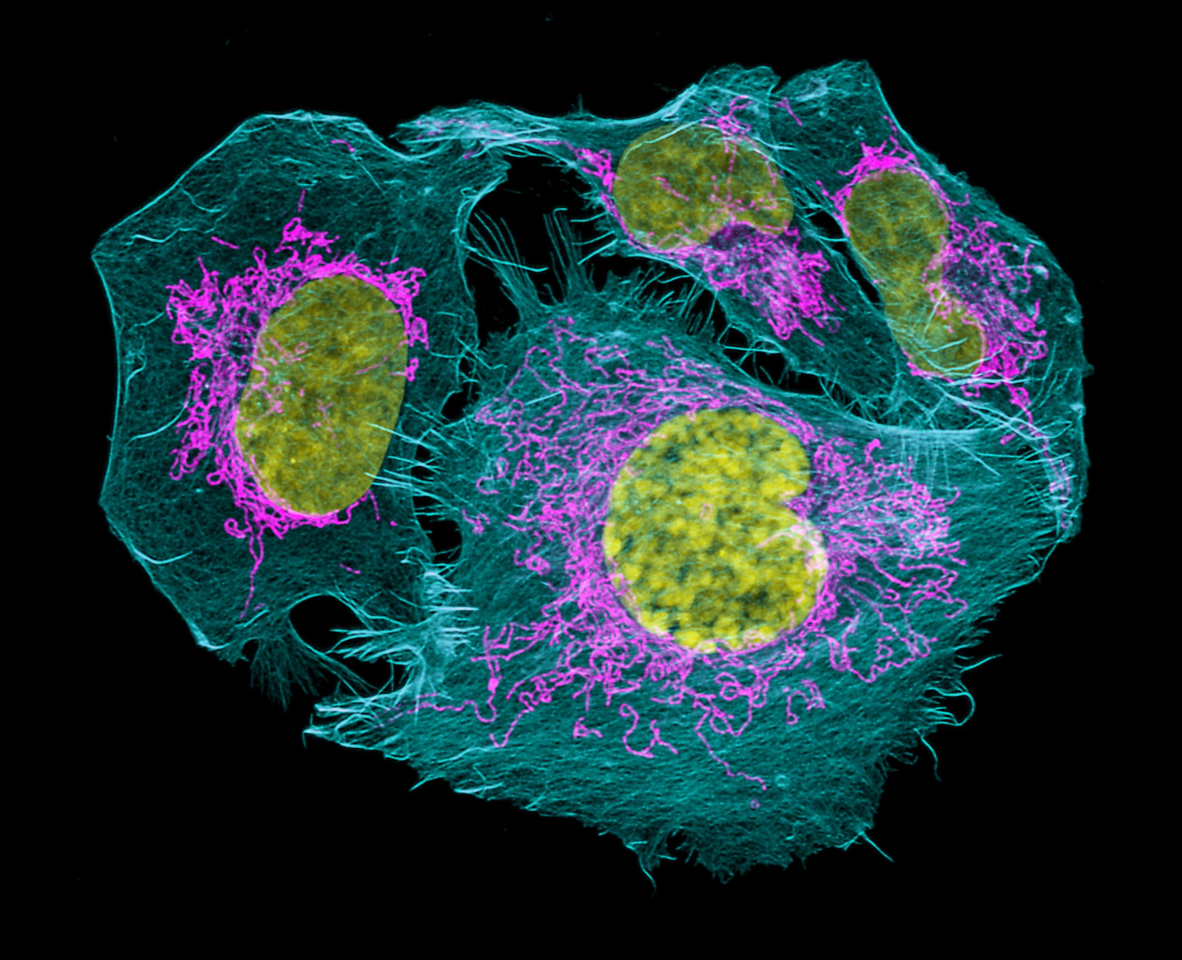 Células de cáncer de próstata.
