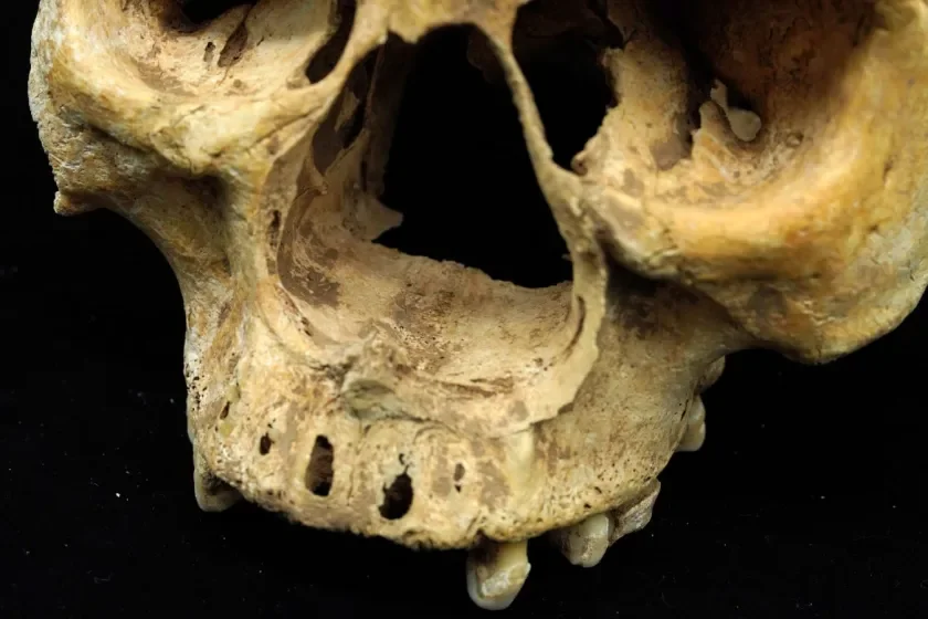 El cráneo de la mujer hallada en el cementerio de Sanzhiyuan presenta lesiones óseas compatibles con una amputación nasal, probablemente practicada como castigo durante la transición entre las dinastías Yuan y Ming.