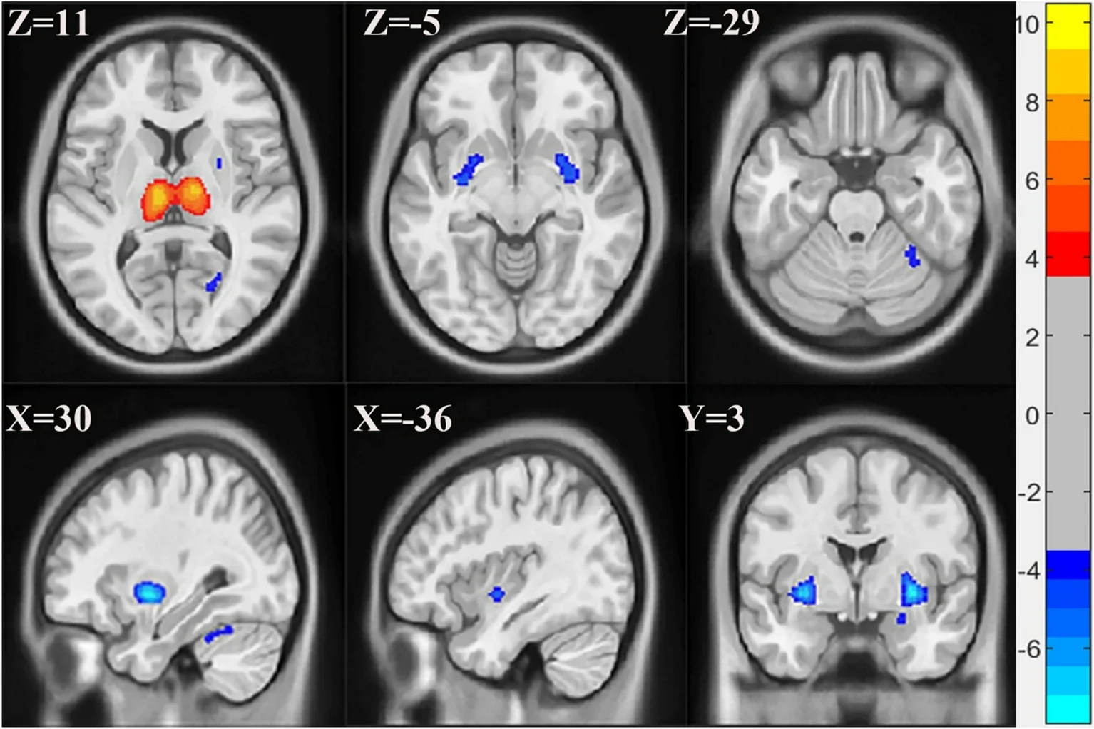 Las imágenes de resonancia magnética muestran diferencias en el volumen de materia gris entre personas con fibromialgia y sujetos sanos.