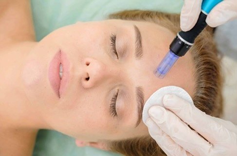NEW SERVICE (acupuncture benefits covered)
Collagen Induction Therapy, also known as Microneedling or Skin Needling is a cosmetic procedure that involves repeatedly puncturing the skin with tiny, sterile single use needles in order to help with esthe