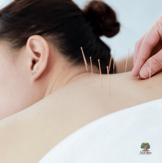Acupuncture Explained: Benefits, Safety, and What to Expect
