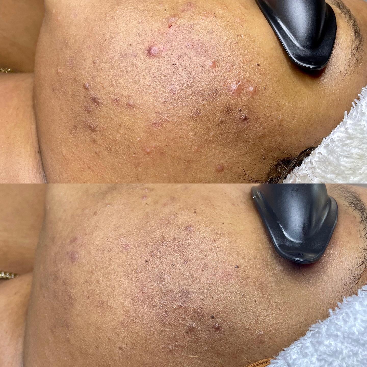 PROGRESS⠀
⠀
4 weeks difference. Subtle, but improvement indeed. 
⠀
Breakouts are clearing, pigmentation has been reduced. Overall skin texture has improved.⠀
⠀
I can&rsquo;t wait to see how much more progress we make as she continues her new home car