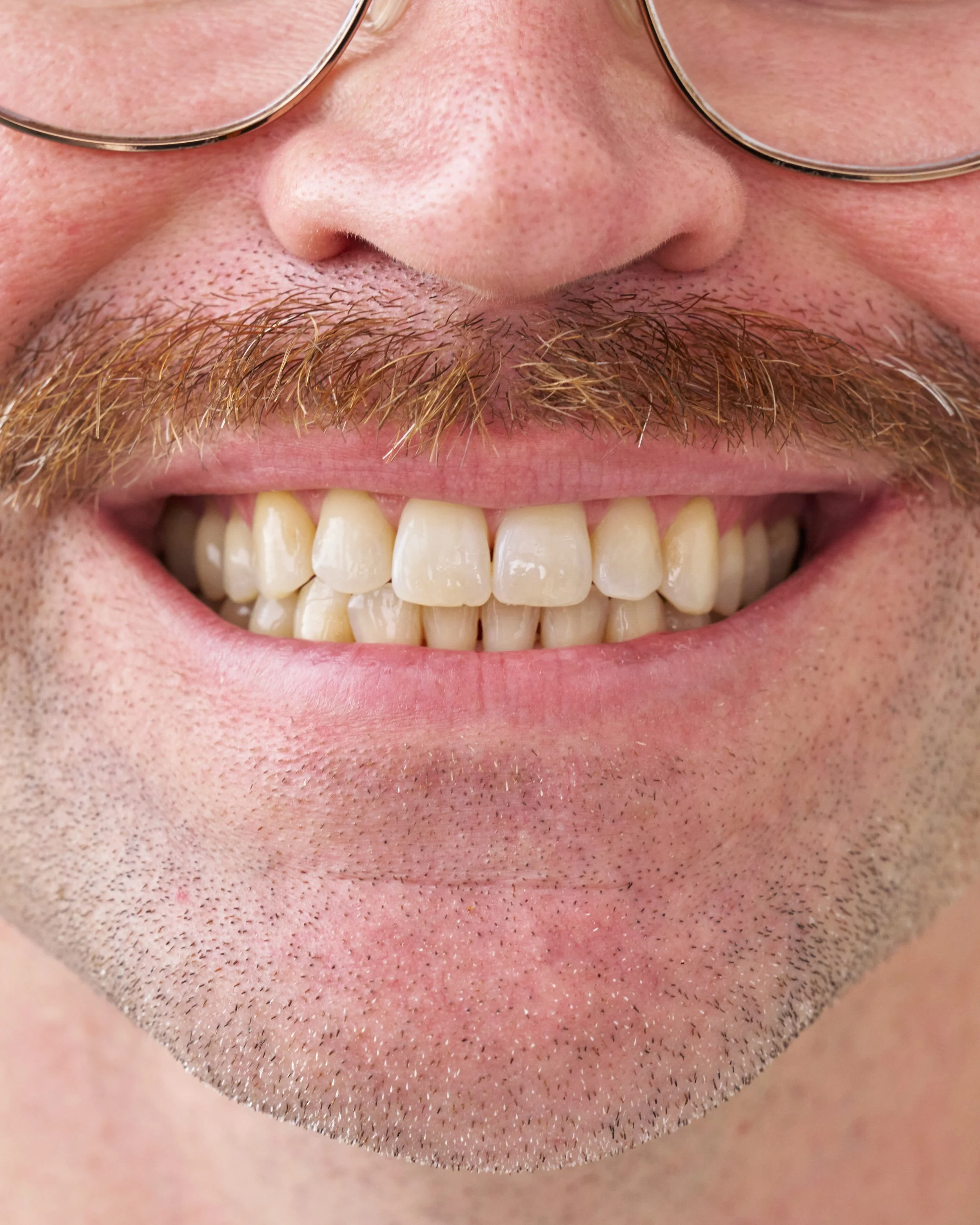 What's the Difference Between In-Chair and Take-Home Whitening?