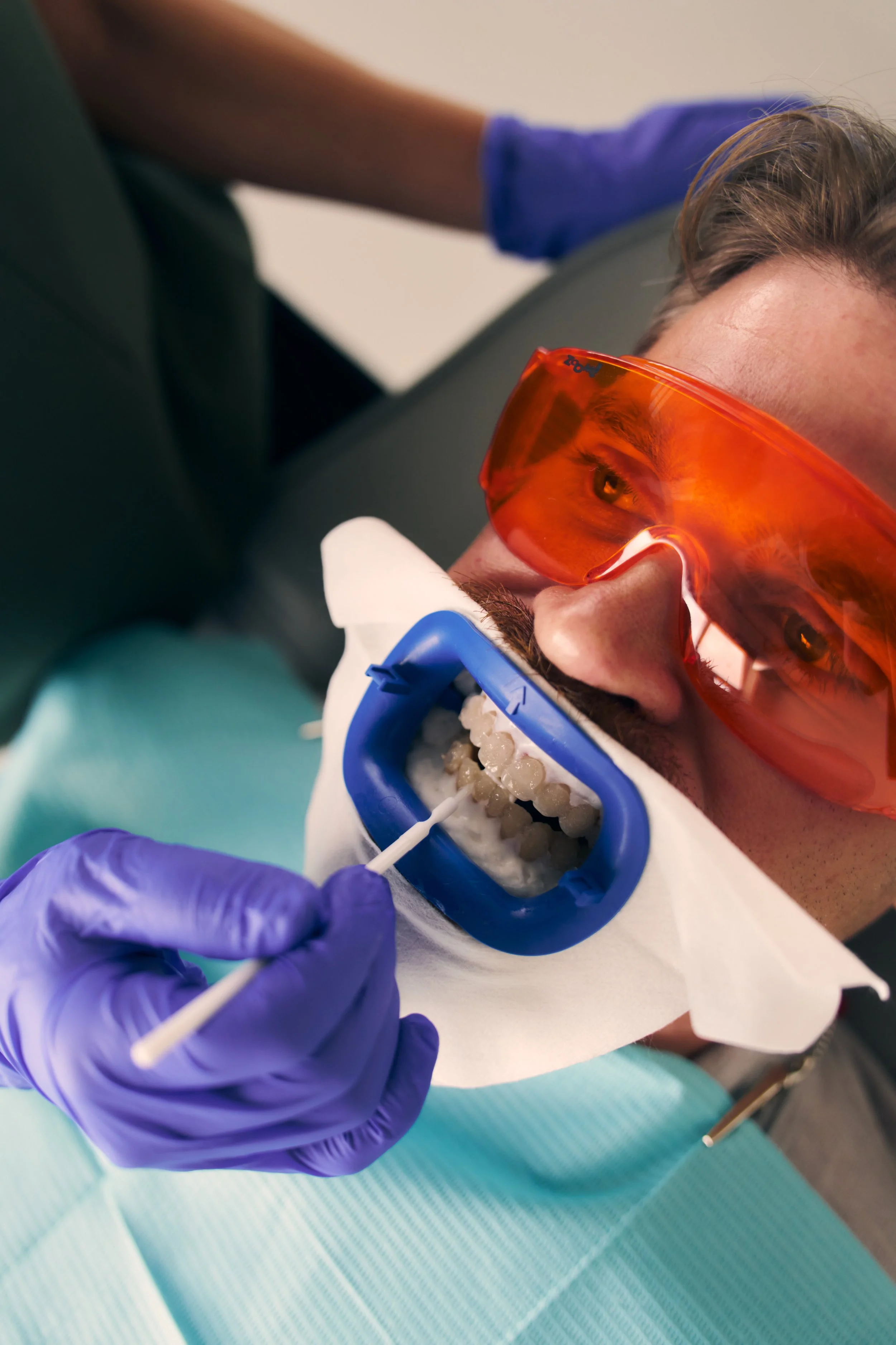 How Long Do Whitening Results Last?