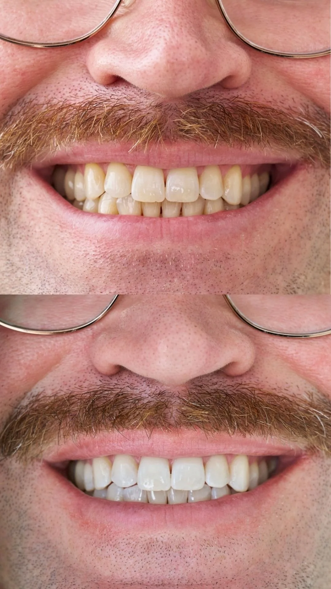 teeth whitening Collingwood Melbourne before and after white teeth white smile