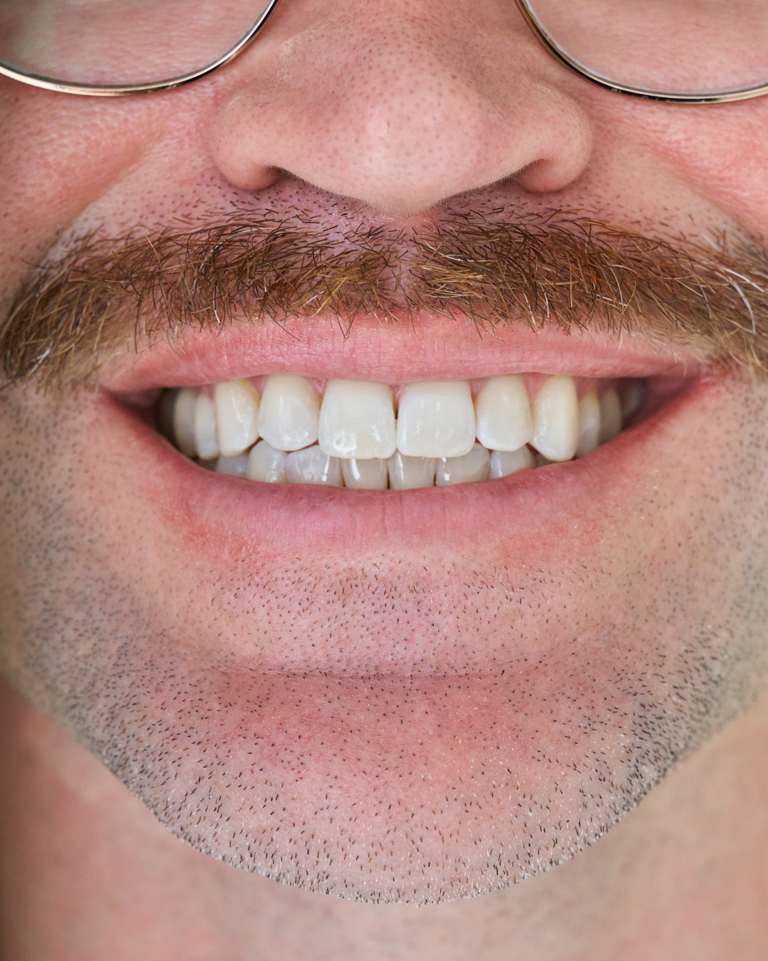 What's the Difference Between In-Chair and Take-Home Whitening?