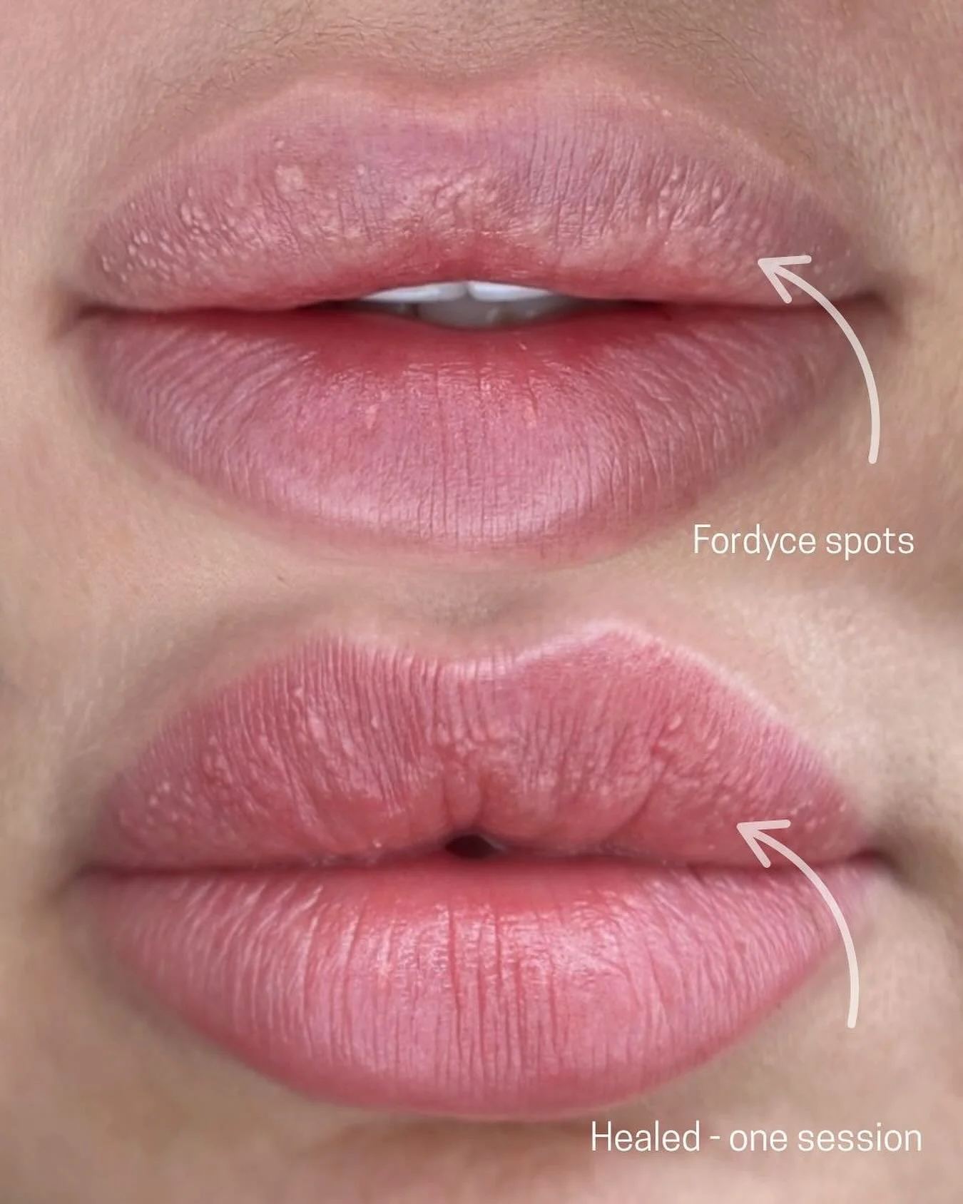 Ever noticed tiny little white or yellowish dots on your lips? They’re called Fordyce spots, totally normal and harmless, but they can sometimes make your lip colour look uneven or add texture to the tissue.
That’s where lip blush comes