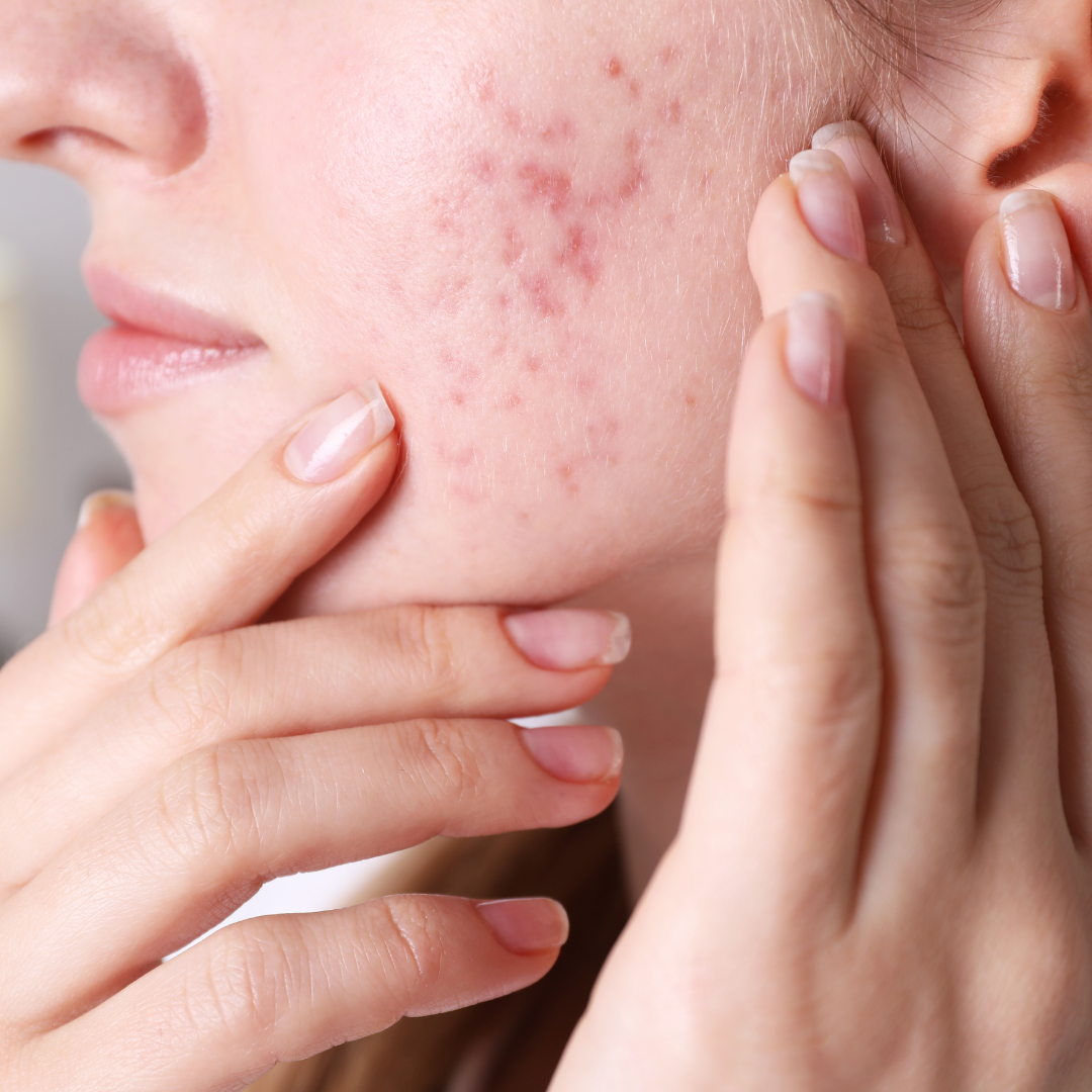 Why Your Acne Scars Haven't Faded After Years